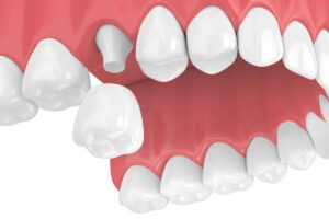 Dental crowns illustration