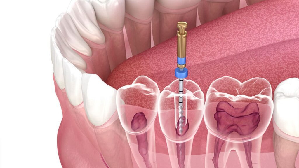 Root Canal Treatment