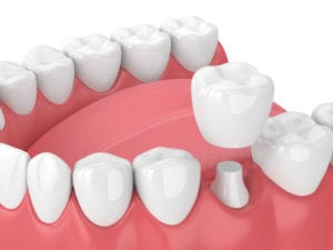 dental crowns Quincy MA