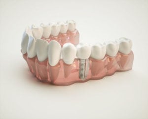 dental implant Quincy MA