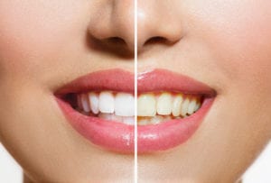 teeth whitening quincy ma