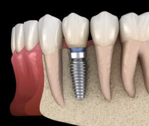 dental implants quincy