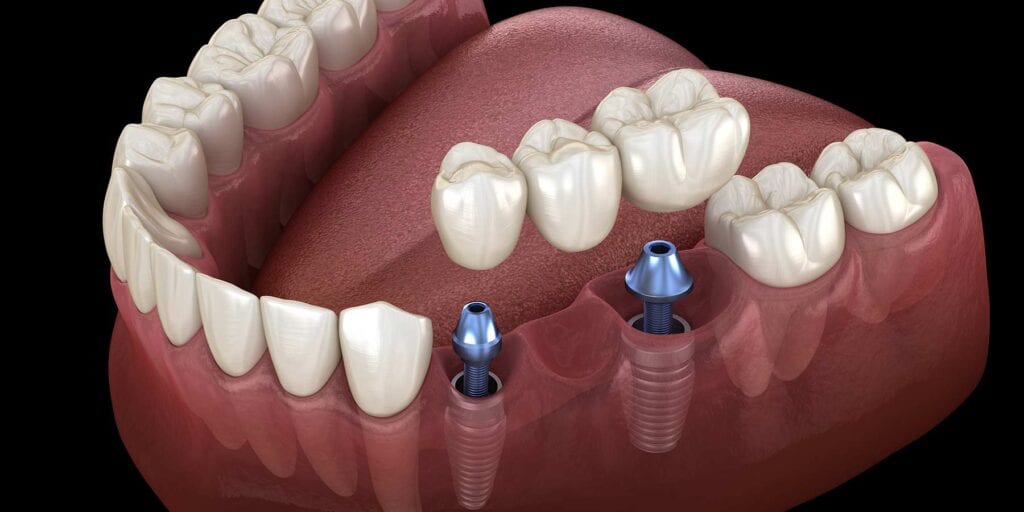 Dental Implants Illustration