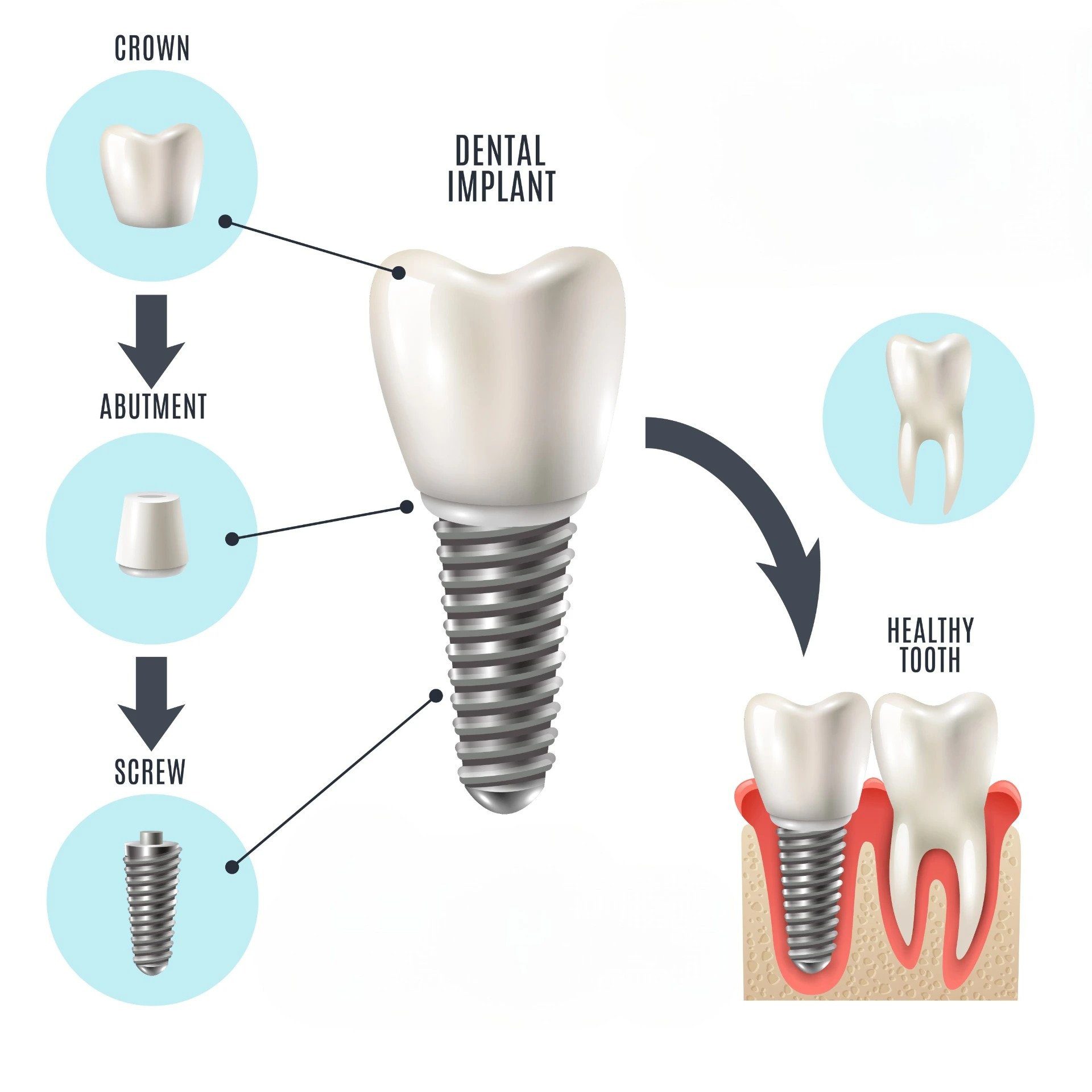 A dental implant is made of three parts: The crown, the abutment, and the screw.